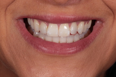 Before Invisalign Treatment Smile Rooms Glasgow