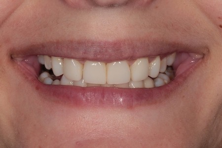 After Veneers Treatment Smile Rooms Glasgow After Veneers Treatment Smile Rooms Glasgow