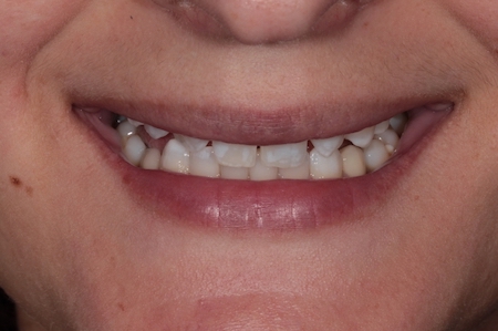 Before veneers Treatment Smile Rooms Glasgow Before veneers Treatment Smile Rooms Glasgow