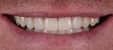 After Invisalign Treatment Smile Rooms Glasgow