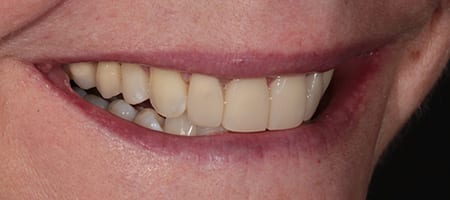 After Invisalign Treatment Smile Rooms Glasgow