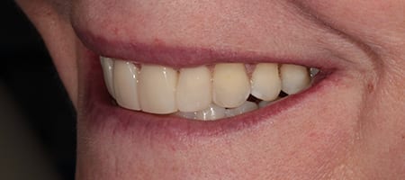 After Invisalign Treatment Smile Rooms Glasgow