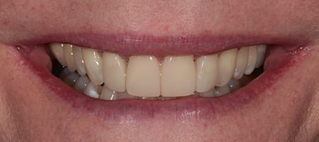 After Invisalign Treatment Smile Rooms Glasgow