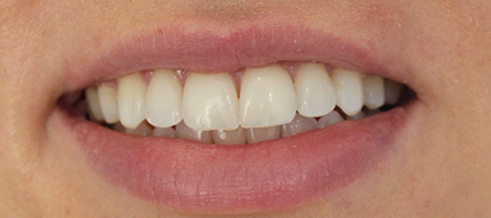 After Invisalign Treatment Smile Rooms Glasgow After Invisalign Treatment Smile Rooms Glasgow