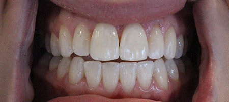After Invisalign Treatment Smile Rooms Glasgow After Invisalign Treatment Smile Rooms Glasgow