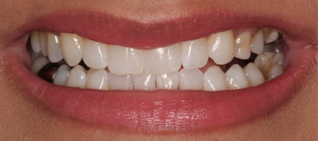 After Invisalign Treatment Smile Rooms Glasgow After Invisalign Treatment Smile Rooms Glasgow
