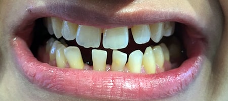 Before Invisalign Treatment Smile Rooms Glasgow Before Invisalign Treatment Smile Rooms Glasgow