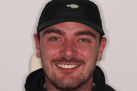 After Invisalign Treatment Smile Rooms Glasgow After Invisalign Treatment Smile Rooms Glasgow