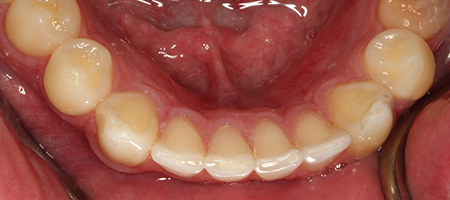 After Invisalign Treatment Smile Rooms Glasgow After Invisalign Treatment Smile Rooms Glasgow