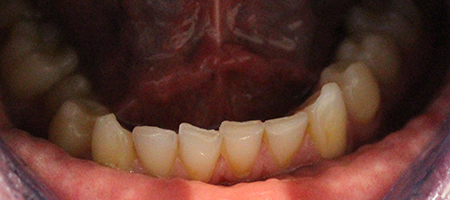 Before Invisalign Treatment Smile Rooms Glasgow Before Invisalign Treatment Smile Rooms Glasgow