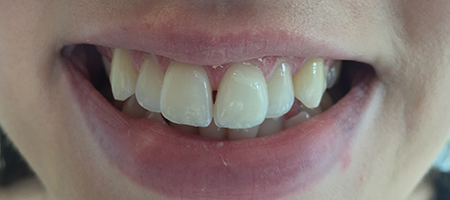 Before Invisalign Treatment Smile Rooms Glasgow Before Invisalign Treatment Smile Rooms Glasgow