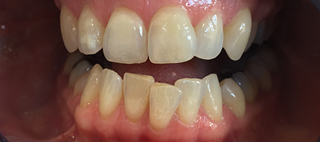 Before Invisalign Treatment Smile Rooms Glasgow Before Invisalign Treatment Smile Rooms Glasgow
