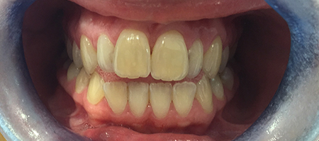 Before Invisalign Treatment Smile Rooms Glasgow Before Invisalign Treatment Smile Rooms Glasgow