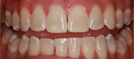 After Invisalign Treatment Smile Rooms Glasgow After Invisalign Treatment Smile Rooms Glasgow