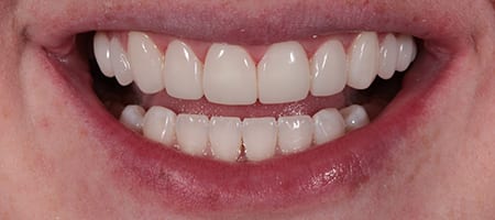 After Invisalign Treatment Smile Rooms Glasgow