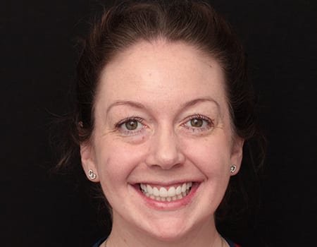 After Invisalign Treatment Smile Rooms Glasgow