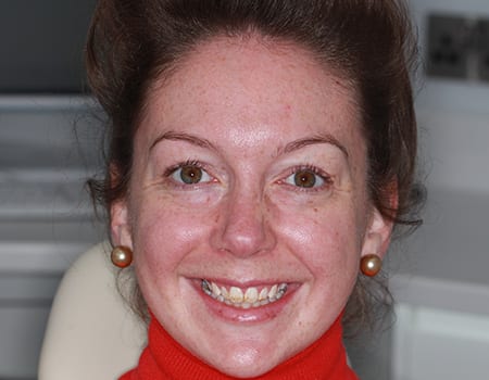 Before & after cosmetic bonding