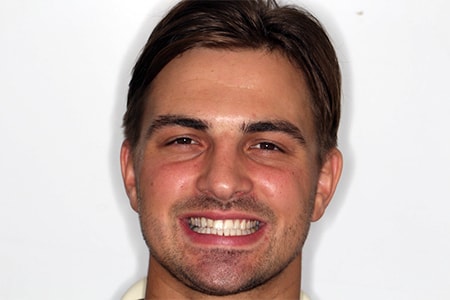 After Invisalign Treatment Smile Rooms Glasgow After Invisalign Treatment Smile Rooms Glasgow