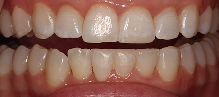 After Invisalign Treatment Smile Rooms Glasgow After Invisalign Treatment Smile Rooms Glasgow