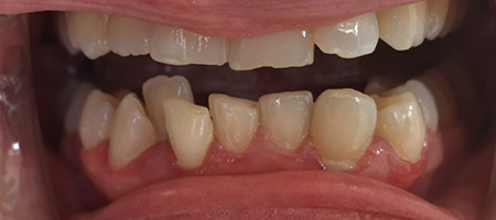 Before Invisalign Treatment Smile Rooms Glasgow Before Invisalign Treatment Smile Rooms Glasgow