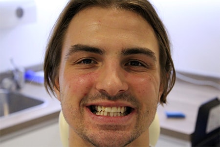 Before Invisalign Treatment Smile Rooms Glasgow Before Invisalign Treatment Smile Rooms Glasgow