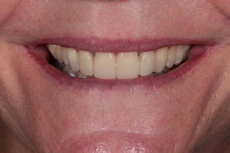 After Smile Makeover Treatment Smile Rooms Glasgow After Smile Makeover Treatment Smile Rooms Glasgow