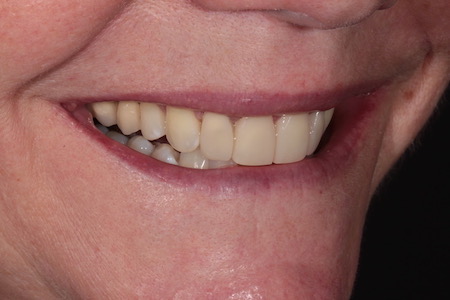 After Smile Makeover Treatment Smile Rooms Glasgow After Smile Makeover Treatment Smile Rooms Glasgow