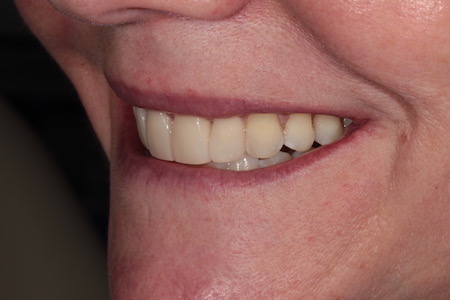 After Smile Makeover Treatment Smile Rooms Glasgow After Smile Makeover Treatment Smile Rooms Glasgow