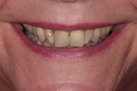 Before Smile Makeover Treatment Smile Rooms Glasgow Before Smile Makeover Treatment Smile Rooms Glasgow