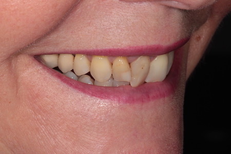 Before Smile Makeover Treatment Smile Rooms Glasgow Before Smile Makeover Treatment Smile Rooms Glasgow