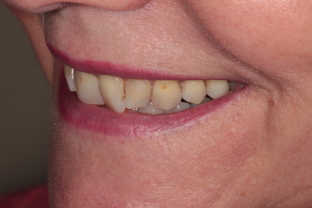 Before Smile Makeover Treatment Smile Rooms Glasgow Before Smile Makeover Treatment Smile Rooms Glasgow