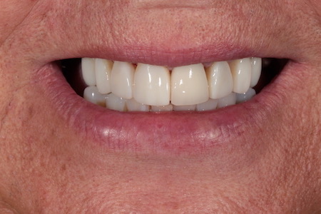 After Veneers Treatment Smile Rooms Glasgow After Veneers Treatment Smile Rooms Glasgow