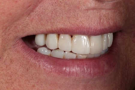 After Smile Makeover Treatment Smile Rooms Glasgow After Smile Makeover Treatment Smile Rooms Glasgow