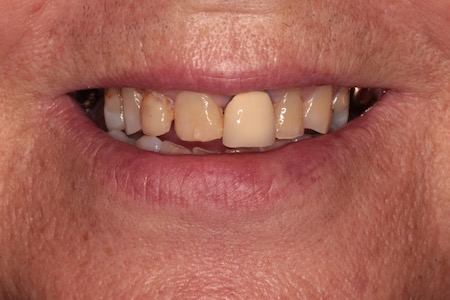 Before veneers Treatment Smile Rooms Glasgow Before veneers Treatment Smile Rooms Glasgow