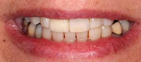 After cosmetic Treatment Smile Rooms Glasgow After cosmetic Treatment Smile Rooms Glasgow
