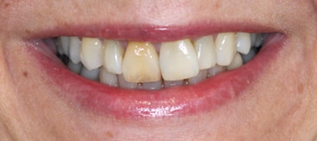 Before cosmetic Treatment Smile Rooms Glasgow Before cosmetic Treatment Smile Rooms Glasgow