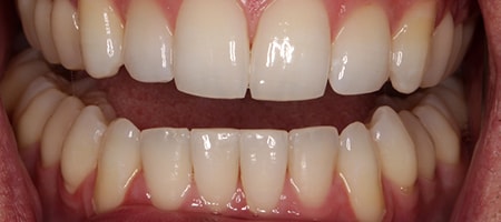 After Invisalign Treatment Smile Rooms Glasgow After Invisalign Treatment Smile Rooms Glasgow