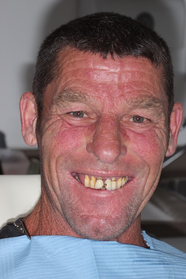 Before & After Dental Implants