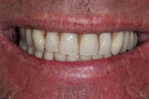 After Invisalign Treatment Smile Rooms Glasgow