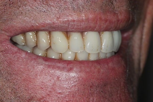 After Invisalign Treatment Smile Rooms Glasgow