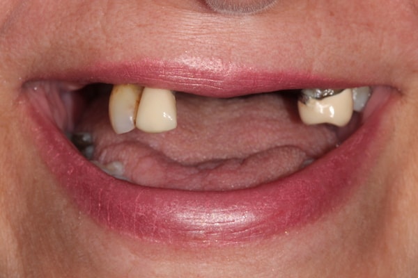 Before Invisalign Treatment Smile Rooms Glasgow