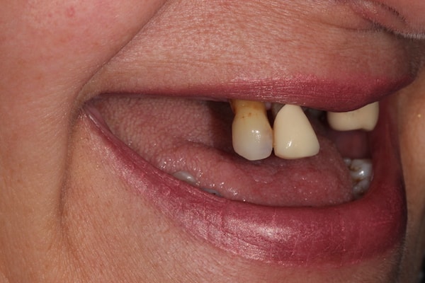 Before Invisalign Treatment Smile Rooms Glasgow