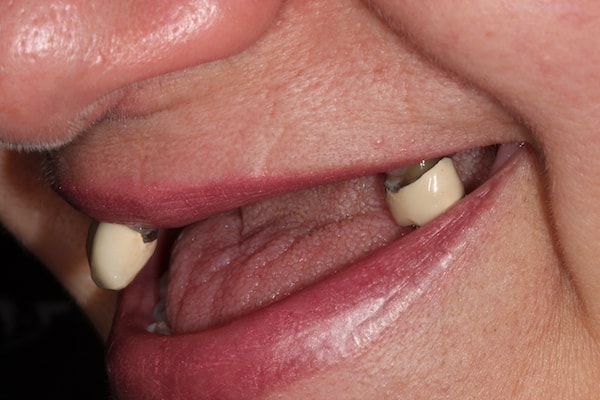 Before Invisalign Treatment Smile Rooms Glasgow