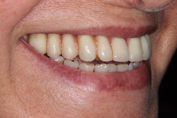 After Invisalign Treatment Smile Rooms Glasgow
