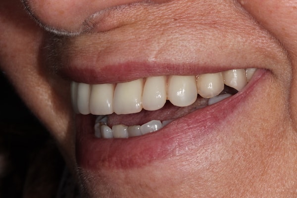 After Invisalign Treatment Smile Rooms Glasgow