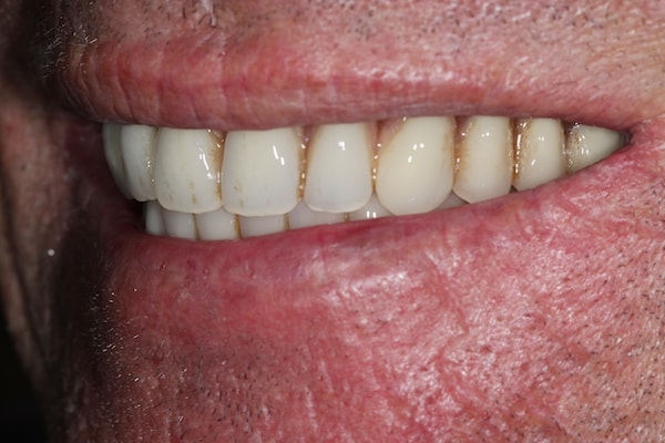 After Invisalign Treatment Smile Rooms Glasgow