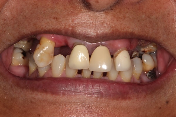 Before Invisalign Treatment Smile Rooms Glasgow