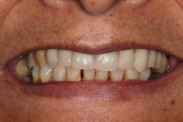 After Invisalign Treatment Smile Rooms Glasgow