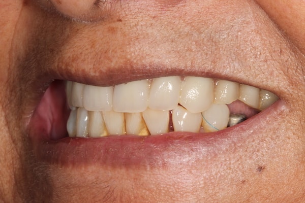 After Invisalign Treatment Smile Rooms Glasgow