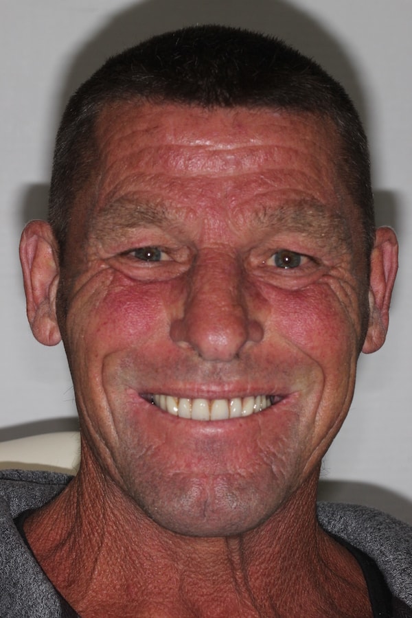 After Invisalign Treatment Smile Rooms Glasgow